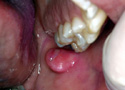 Fibroma